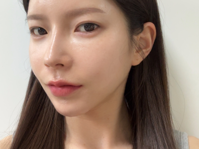 팔자필러 시술 후