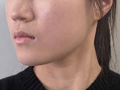 온다 시술 전