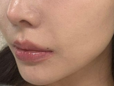 써마지 시술 전