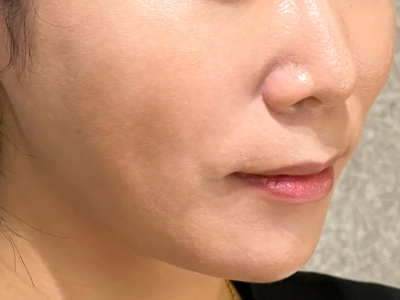 줄기세포 시술 후