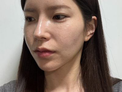 팔자필러 시술 전