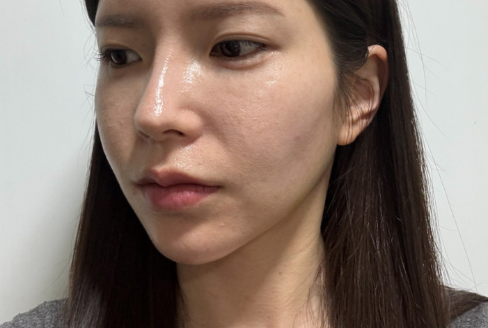 팔자필러 시술 전