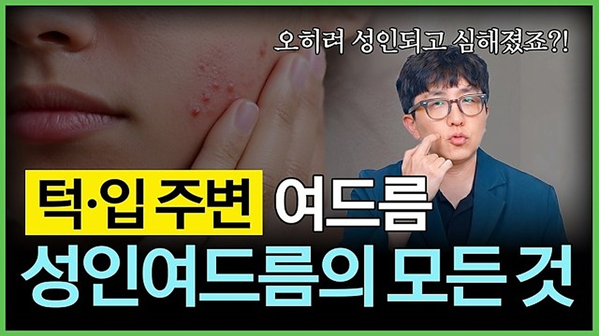 여드름 원인·치료 안내 영상 썸네일